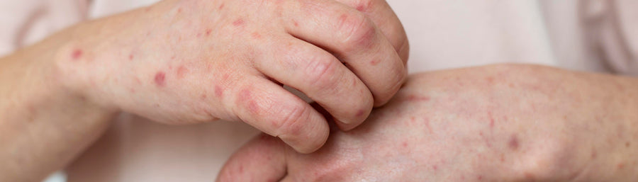 Hypersensibilité aux médicaments : génétique et toxicité médicamenteuse